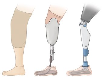 Three types of leg prosthesis.