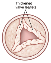 Top view of open aortic valve with thickened leaflets.