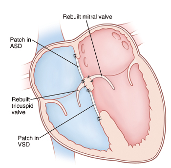 Front view cross section of heart showing atria on top and ventricles on bottom. Mitral and tricuspid valves are rebuilt. Patch is in ASD and another patch in VSD.
