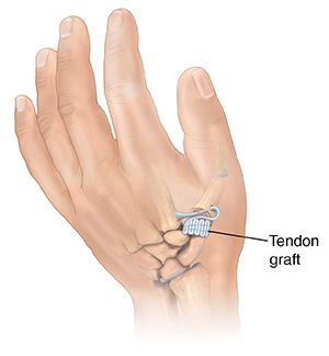 Back view of hand showing ligament graft replacing joint at base of thumb.