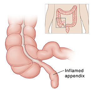 Closeup of colon showing inflamed appendix. Inset shows location of colon.