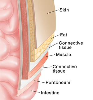 Cross section of abdominal wall over intestine showing layers: skin, fat, fascia, muscle, and peritoneum.