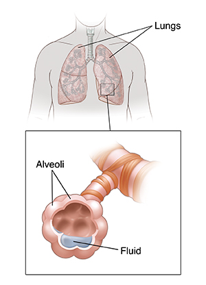 Front view of chest showing lungs. Inset shows alveoli filled with fluid.