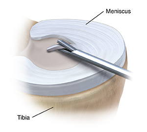 Meniscus showing instrument removing piece of meniscus from inside edge.
