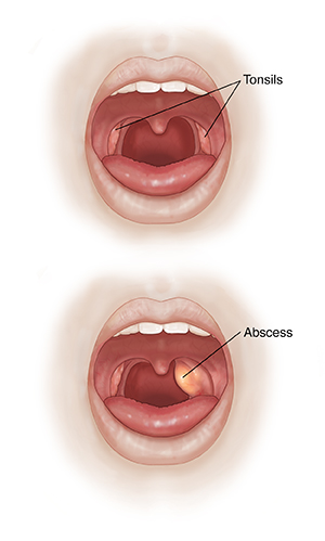 Two images of open mouth showing normal oral cavity and peritonsillar abcess.