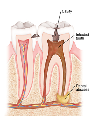 Cross section of two teeth showing cavity, infection, and dental abscess.