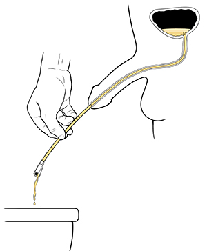 Hand holding catheter draining urine from bladder into toilet.