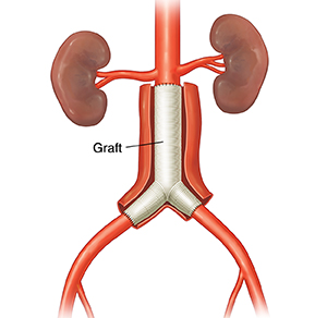 Open surgery to place graft for abdominal aortic aneurysm.