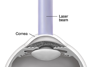 Cross section side view of front of eye showing flap of cornea folded back and laser beam on cornea.