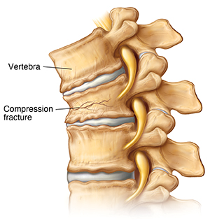 Side view of thoracic veretebrae showing a vertebral compression fracture.