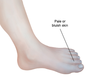 Foot and ankle showing bluish color on toes and forefoot.