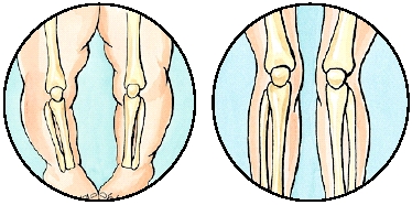 Knees turned out (bowlegs) or in (knock knees)