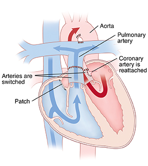 Front view cross section of heart showing repair for transposition of the great arteries.
