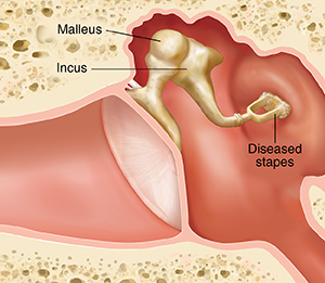 Cross section of ear showing outer, inner, and middle ear structures with damaged stapes.