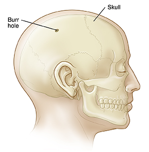 Side view of head with skull showing burr hole.