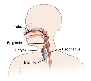 Outline of viewing tube going through the nose to view throat