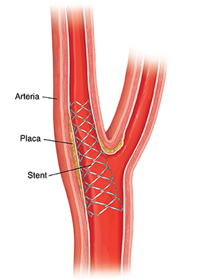 Corte transversal de la arteria carótida con un stent para mantenerla abierta.