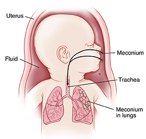 Baby in uterus with head turned to side showing trachea and lungs. Meconium is in fluid inside amniotic fluid. Arrows show meconium going through nose and mouth into lungs.